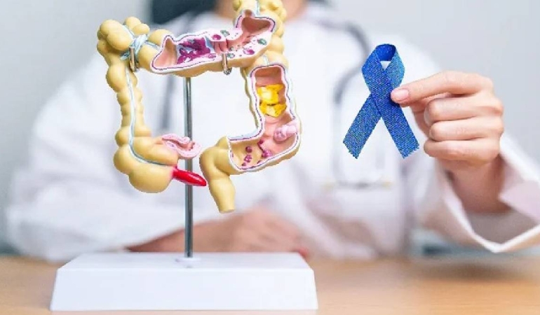 Uzmanlar uyardı: Gençlerde kolon kanseri artıyor